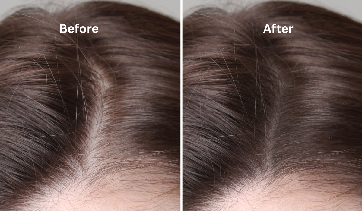 Hairline Lowering Surgery
